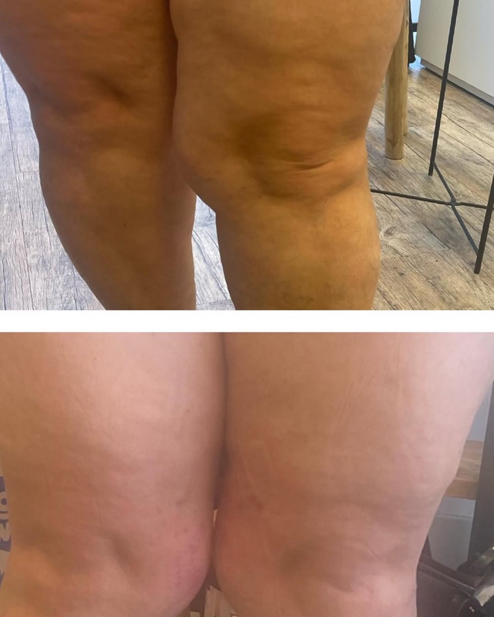 Benen voor en na een cupping-behandeling bij oedeem
